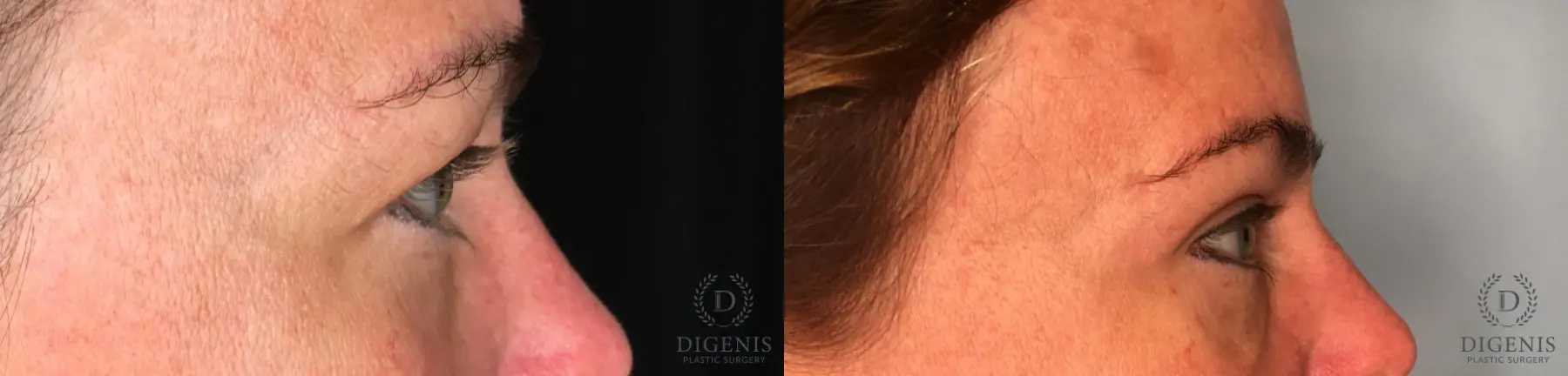 Blepharoplasty: Patient 9 - Before and After 3