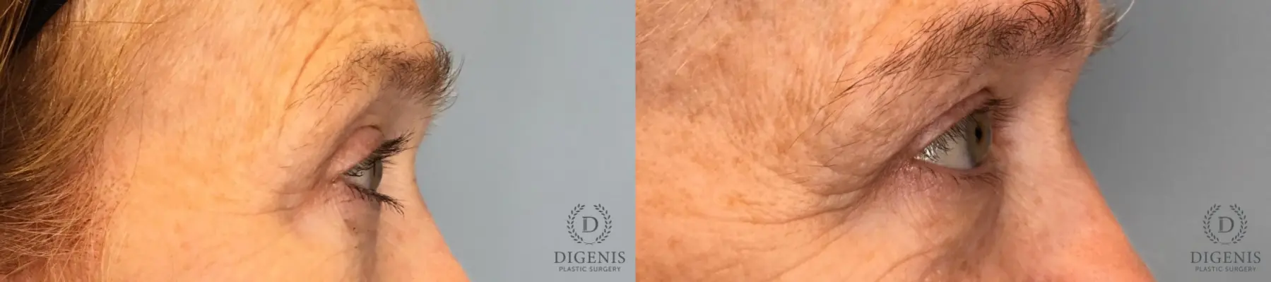 Blepharoplasty: Patient 1 - Before and After 4