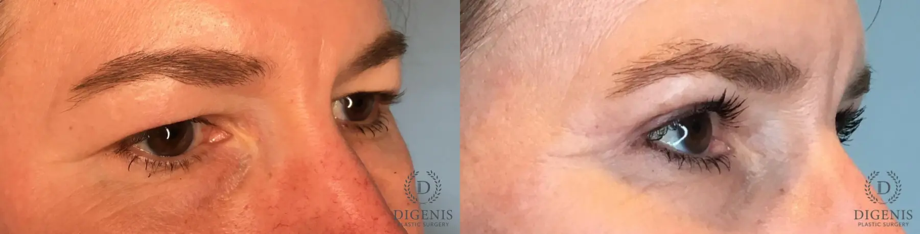 Blepharoplasty: Patient 1 - Before and After 4
