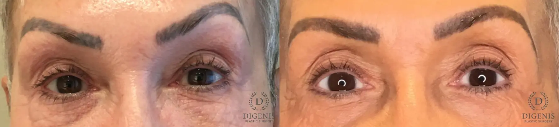 Blepharoplasty: Patient 18 - Before and After  