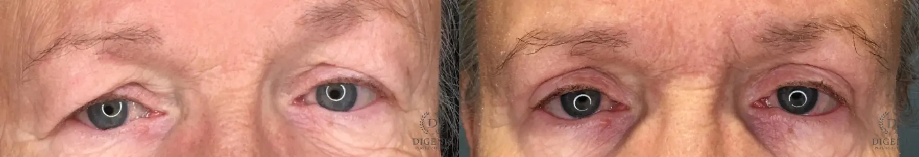 Blepharoplasty: Patient 19 - Before and After  