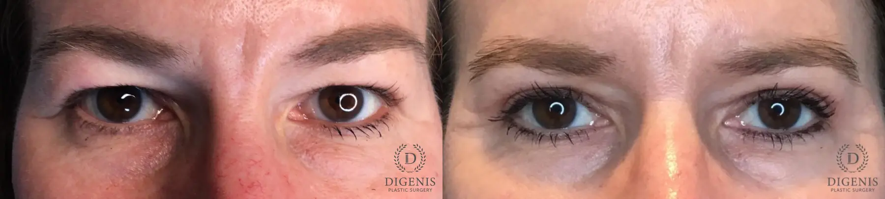 Blepharoplasty: Patient 1 - Before and After  