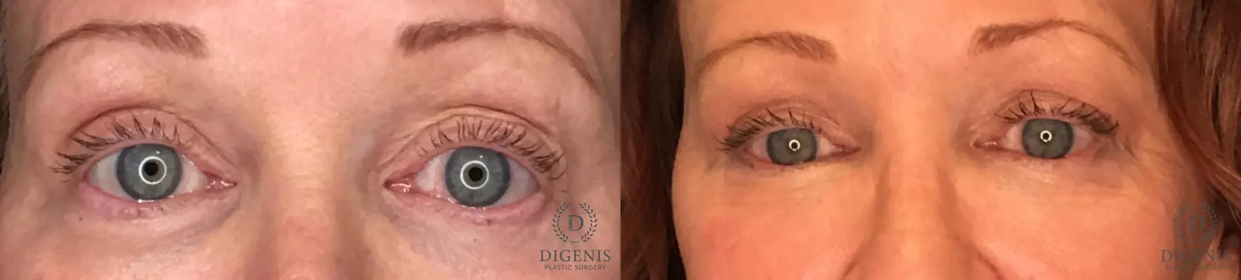 Blepharoplasty: Patient 5 - Before and After  