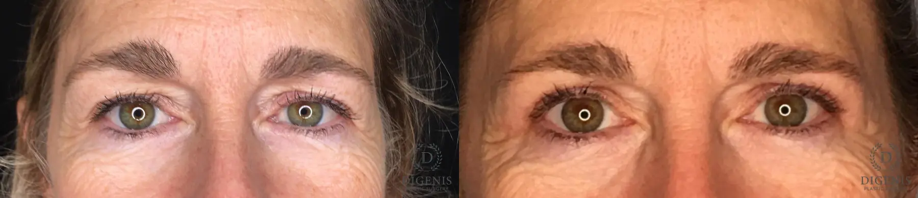 Blepharoplasty: Patient 6 - Before and After  