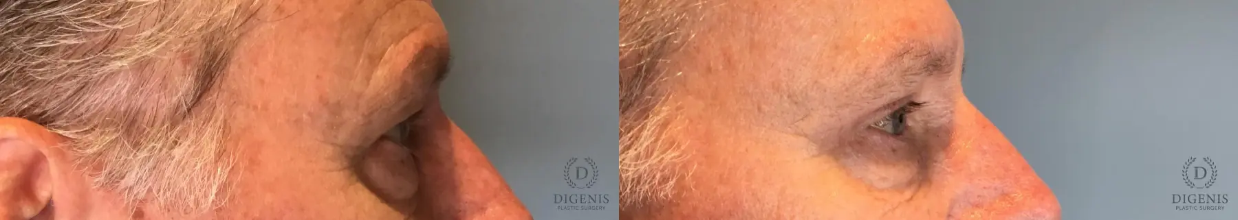 Blepharoplasty: Patient 2 - Before and After 3