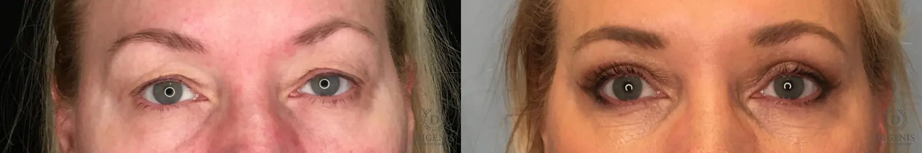 Blepharoplasty: Patient 2 - Before and After 1