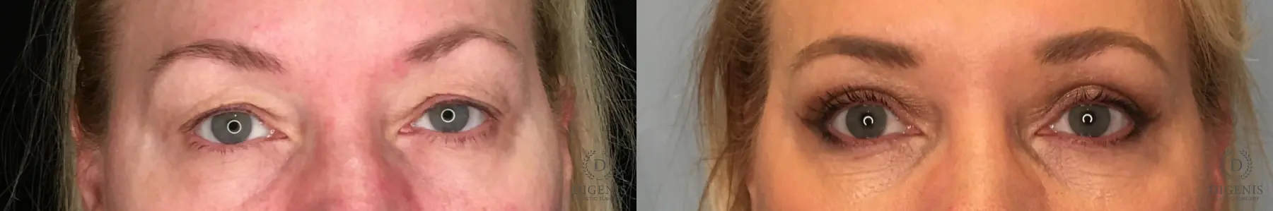 Blepharoplasty: Patient 2 - Before and After  