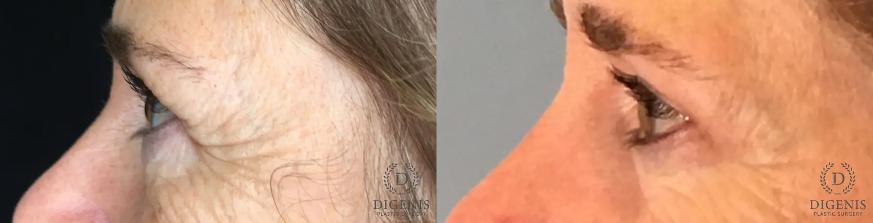 Blepharoplasty: Patient 6 - Before and After 3