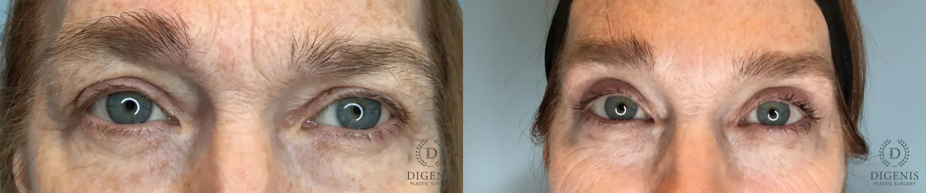 Blepharoplasty: Patient 1 - Before and After  