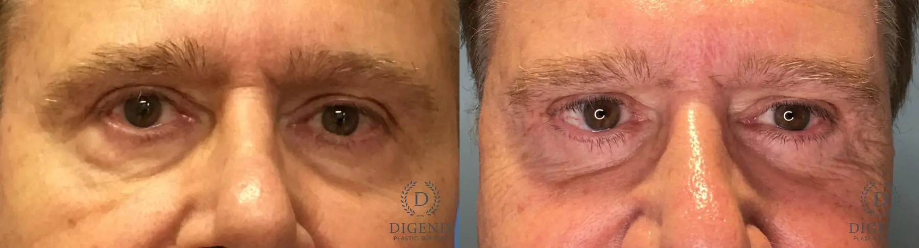 Blepharoplasty: Patient 14 - Before and After  
