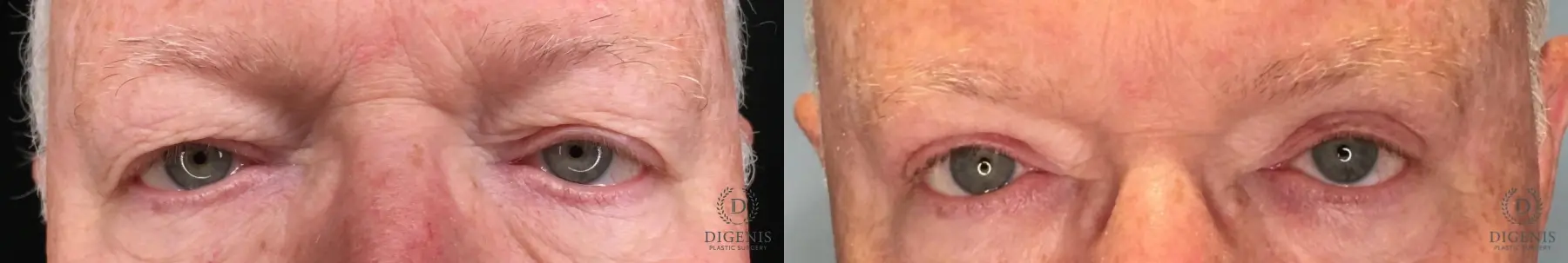 Blepharoplasty: Patient 7 - Before and After  