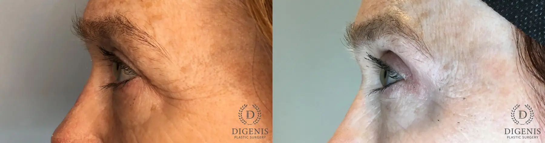 Blepharoplasty: Patient 1 - Before and After 3