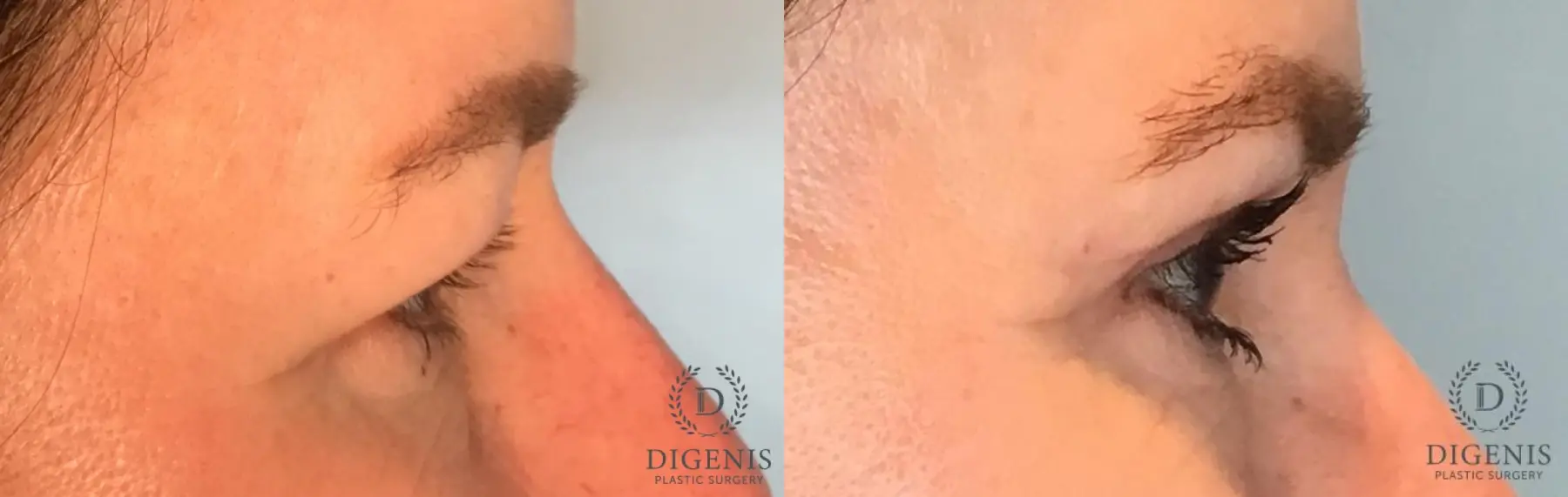 Blepharoplasty: Patient 1 - Before and After 5