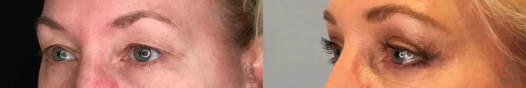 Blepharoplasty: Patient 2 - Before and After 2