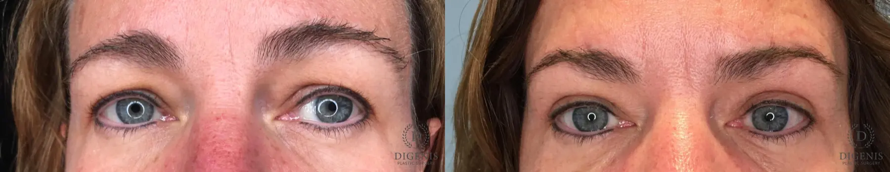 Blepharoplasty: Patient 9 - Before and After 1