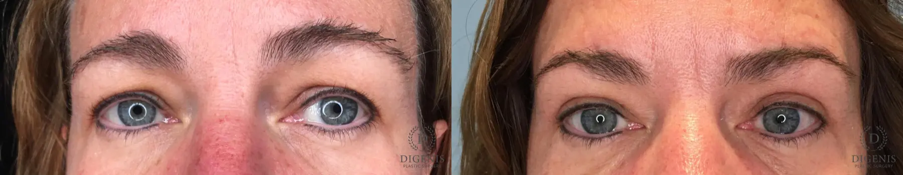 Blepharoplasty: Patient 11 - Before and After  