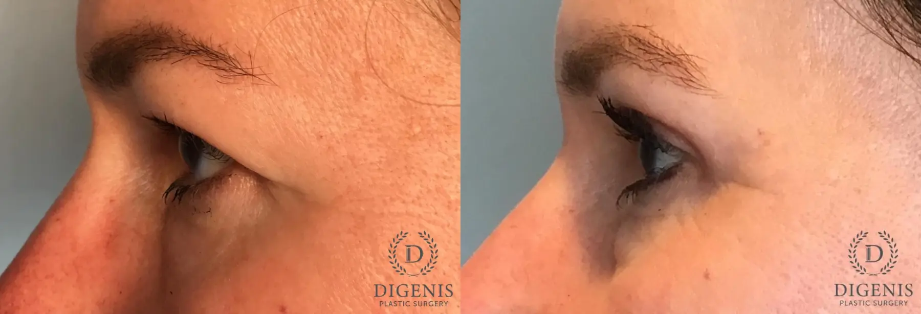 Blepharoplasty: Patient 1 - Before and After 3