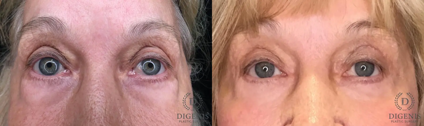 Blepharoplasty: Patient 1 - Before and After  