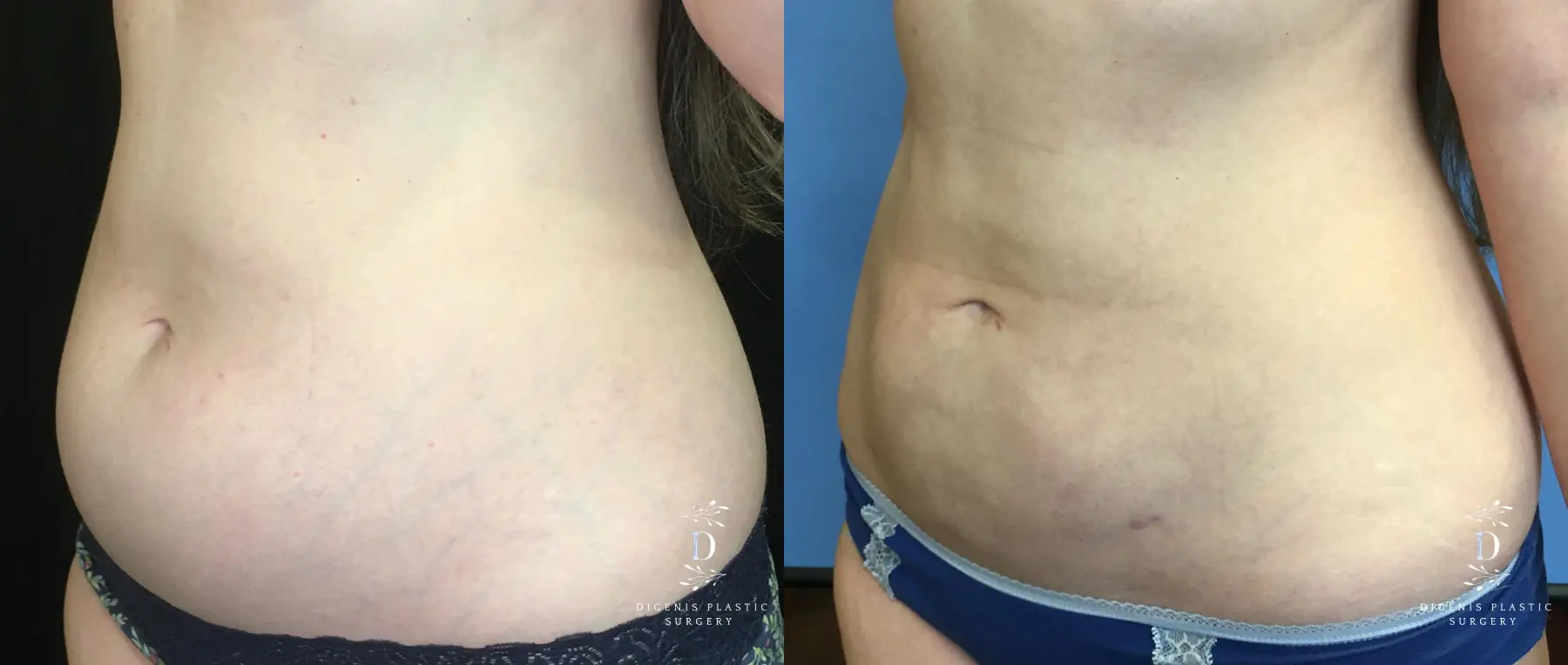 BodyTite: Patient 1 - Before and After 4