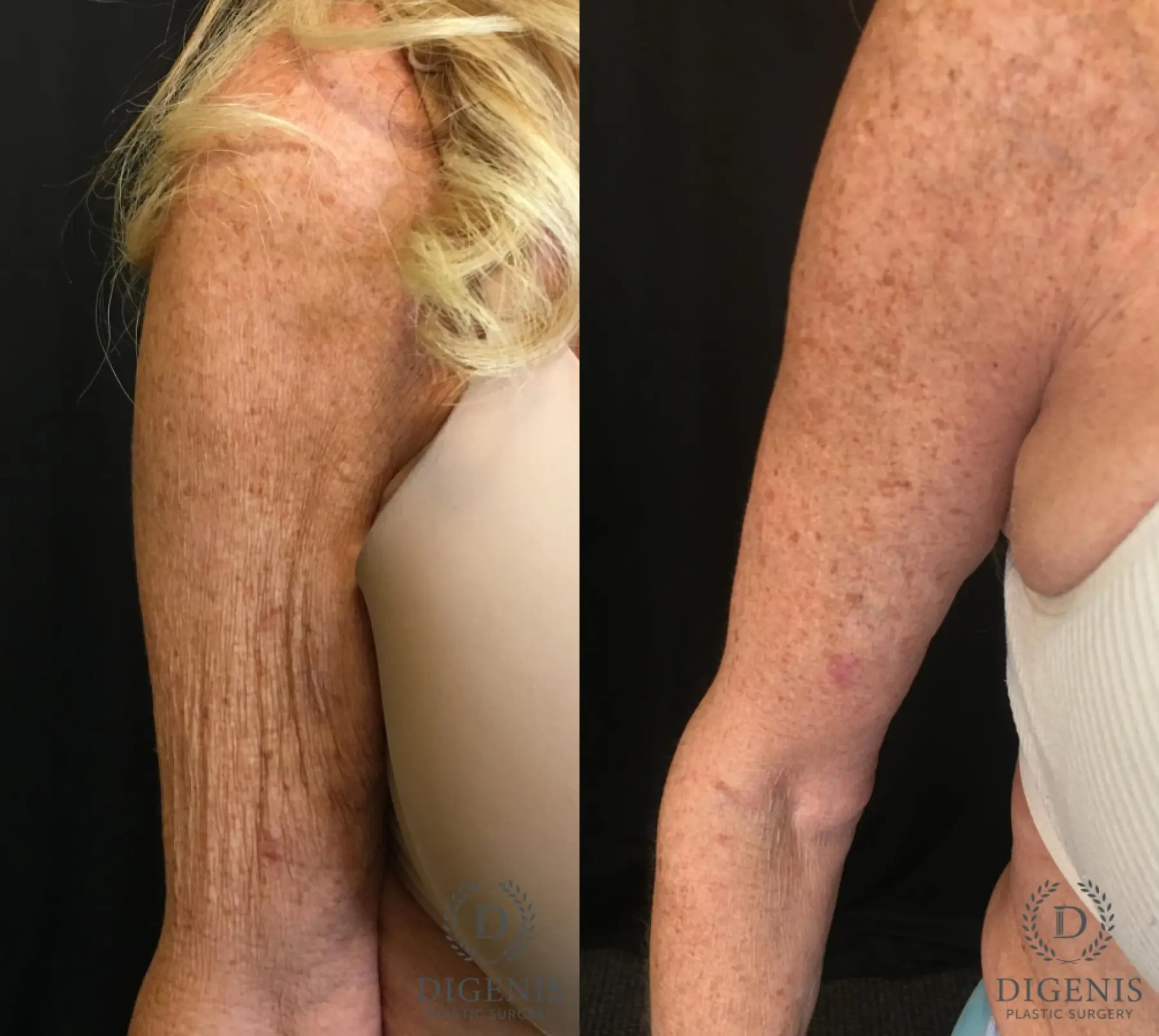 Brachioplasty: Patient 1 - Before and After 3