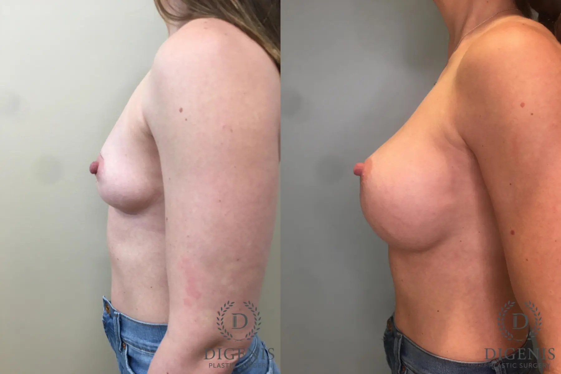 Breast Augmentation: Patient 32 - Before and After 5