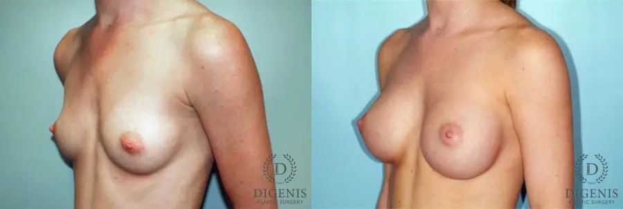 Breast Augmentation: Patient 2 - Before and After  