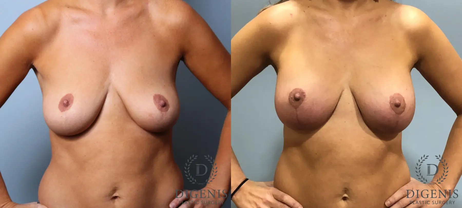 Breast Augmentation: Patient 11 - Before and After  