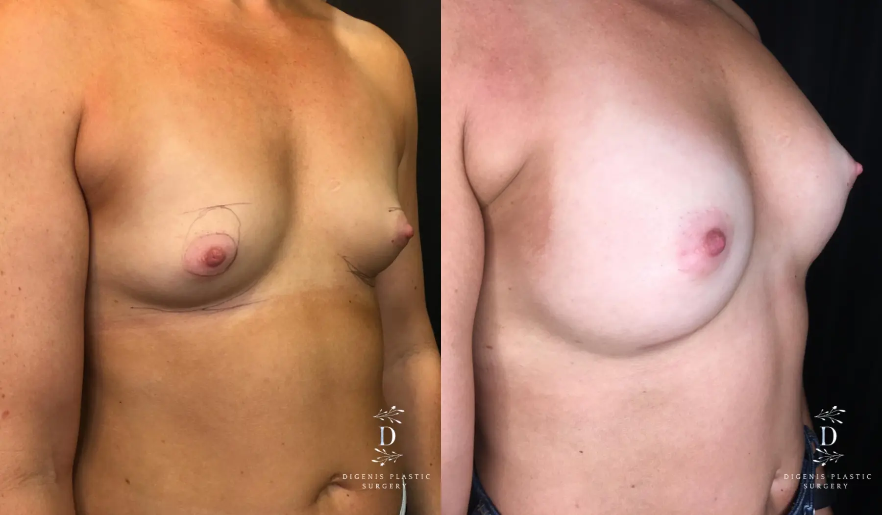 Breast Augmentation: Patient 19 - Before and After 2
