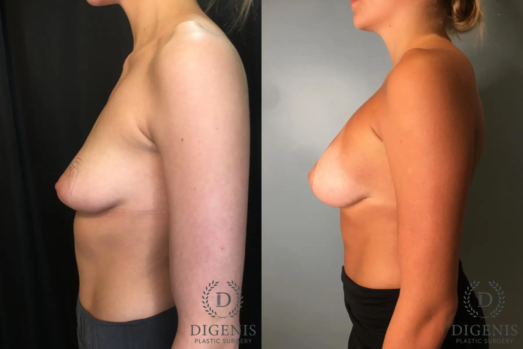 Breast Augmentation: Patient 31 - Before and After 5