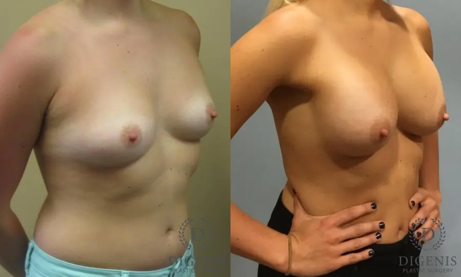 Breast Augmentation: Patient 4 - Before and After 2