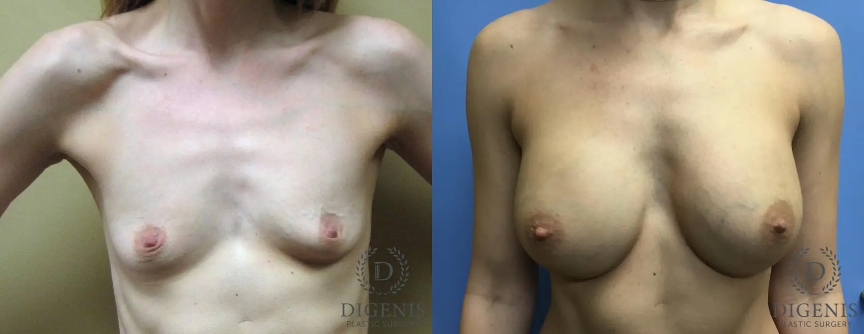 Breast Augmentation: Patient 3 - Before and After  