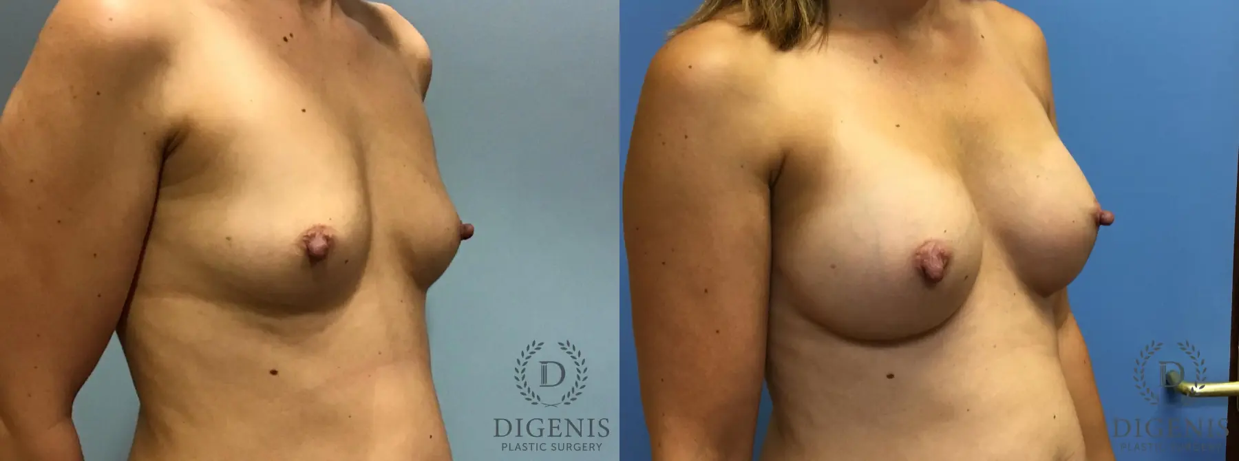 Breast Augmentation: Patient 9 - Before and After 2