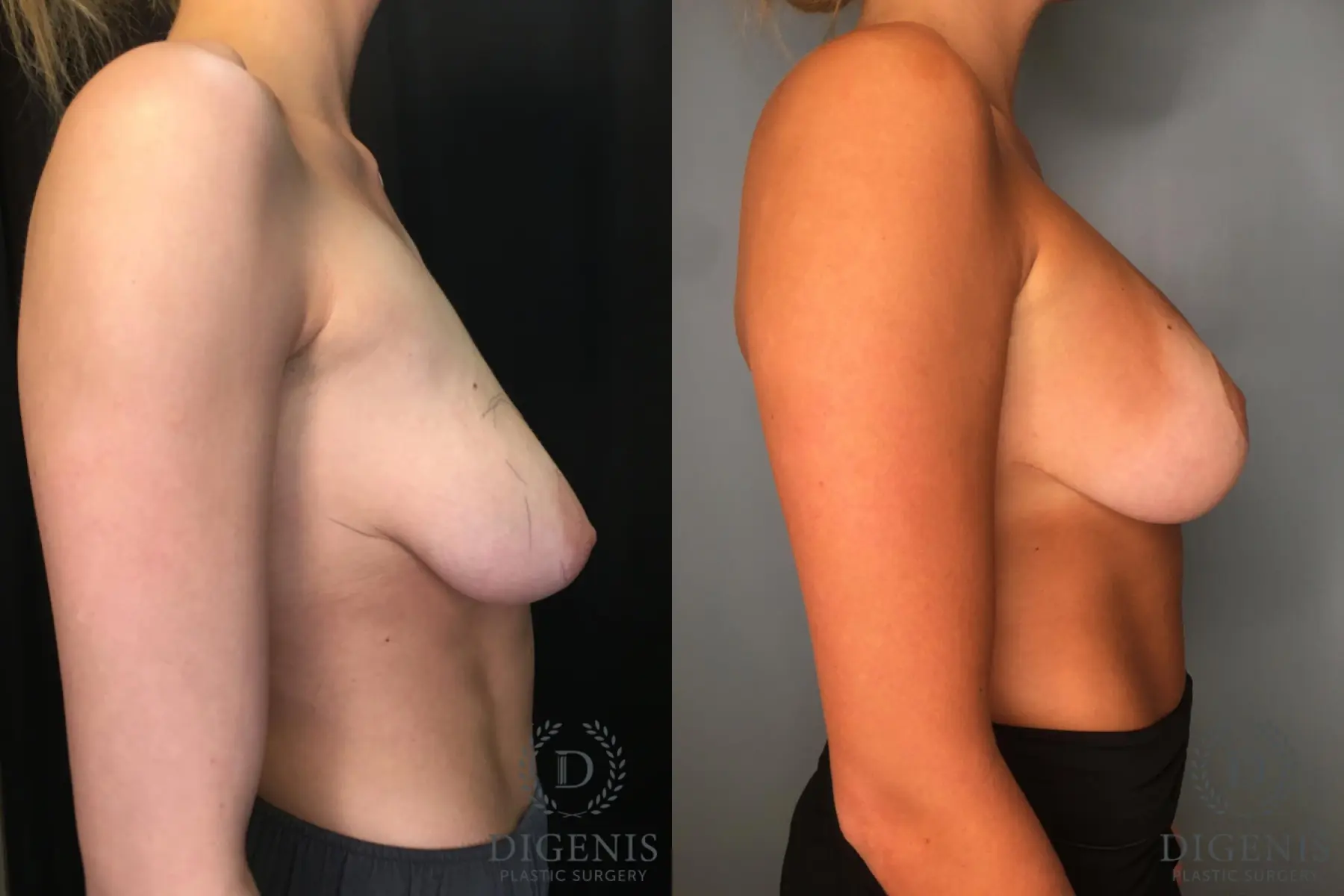 Breast Augmentation: Patient 31 - Before and After 3