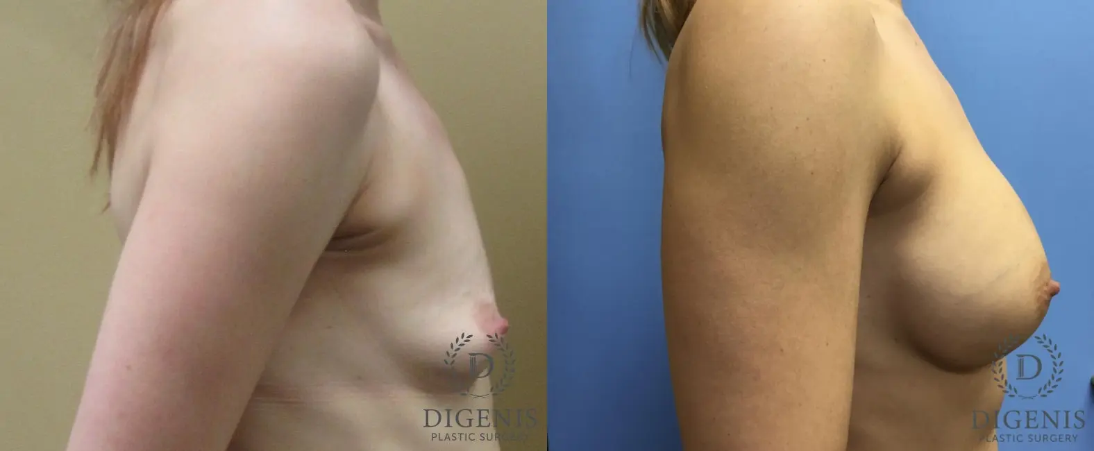 Breast Augmentation: Patient 3 - Before and After 3