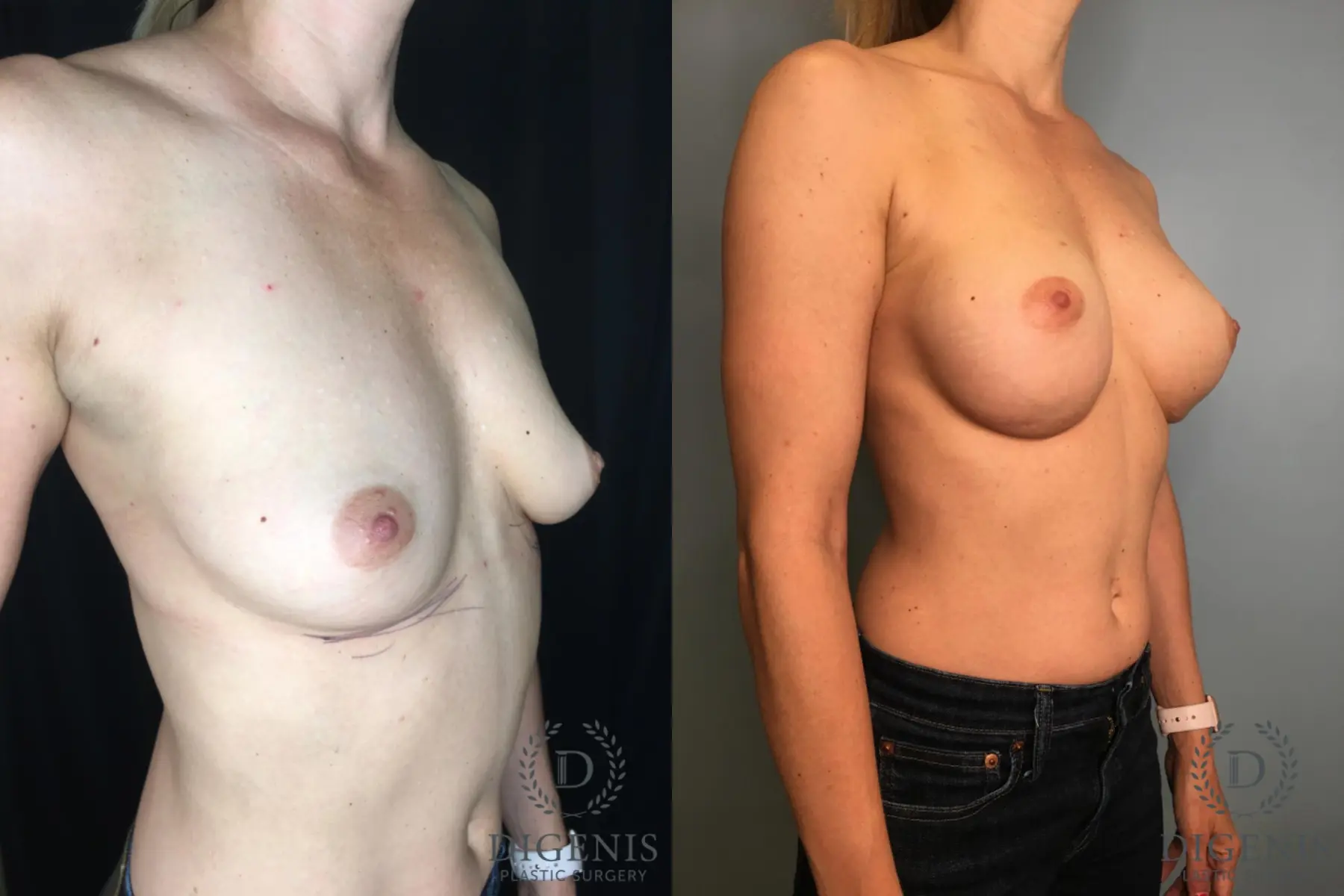 Breast Augmentation: Patient 29 - Before and After 2