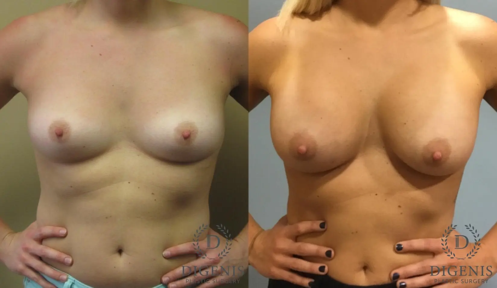 Breast Augmentation: Patient 4 - Before and After  