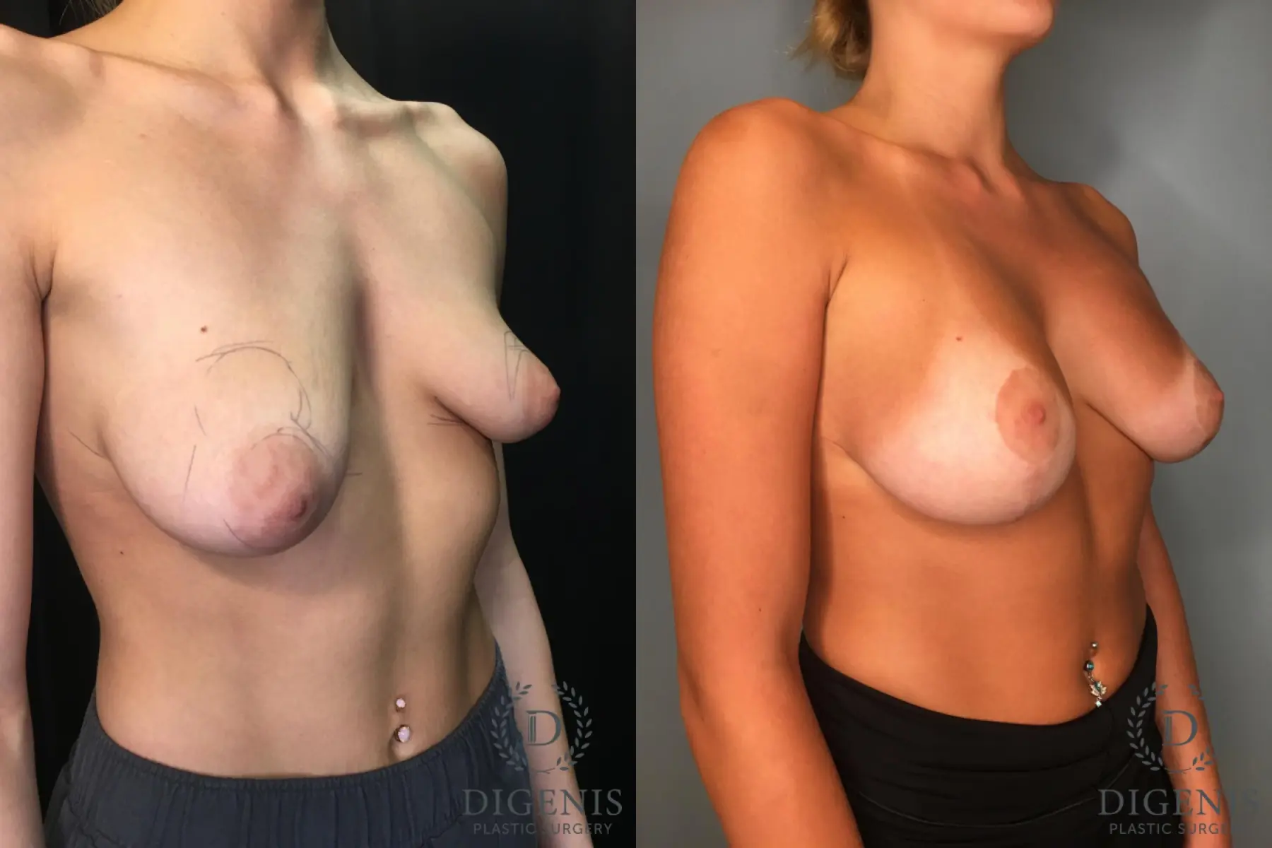 Breast Augmentation: Patient 31 - Before and After 2