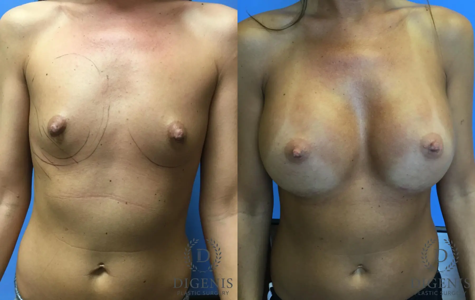 Breast Augmentation: Patient 10 - Before and After  