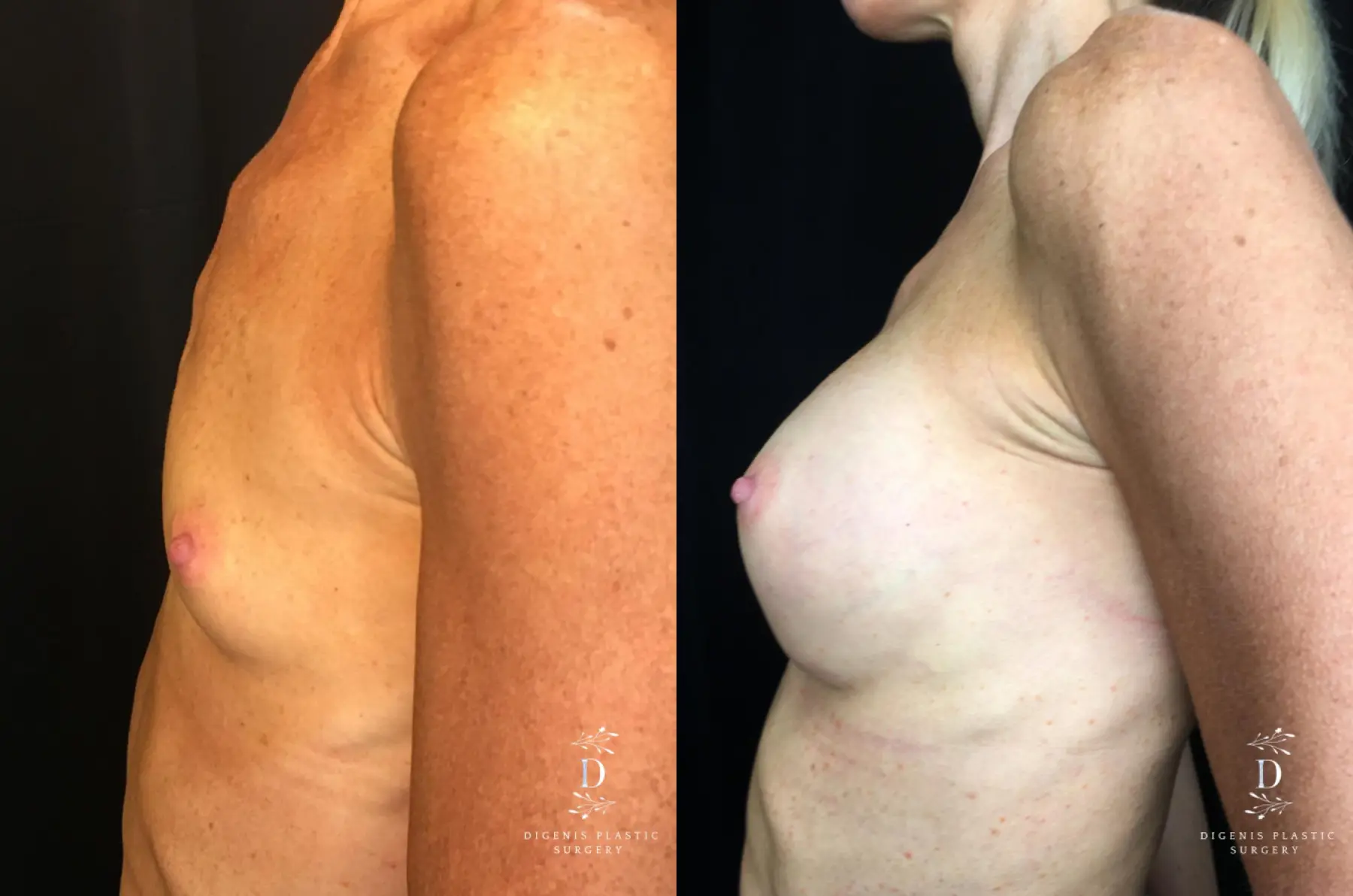 Breast Augmentation: Patient 20 - Before and After 5