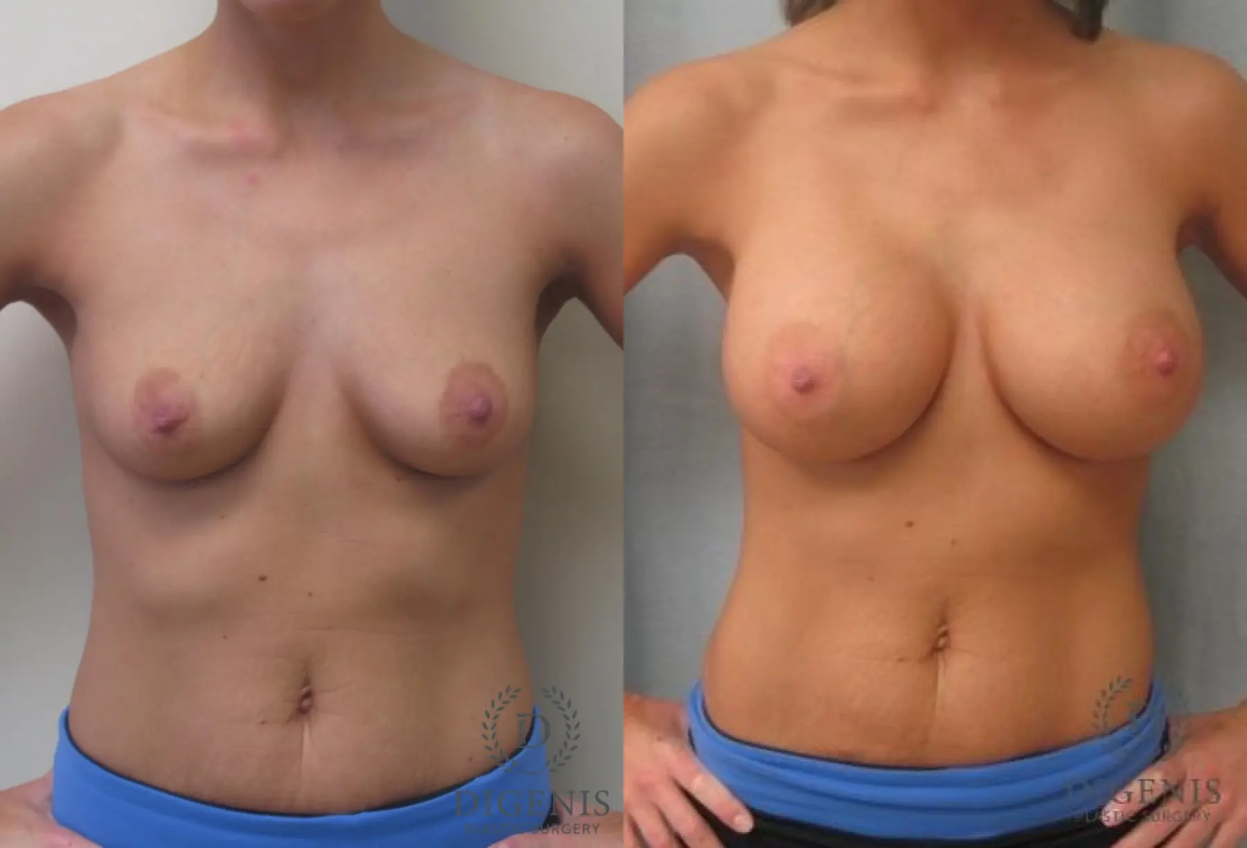 Breast Augmentation: Patient 6 - Before and After  