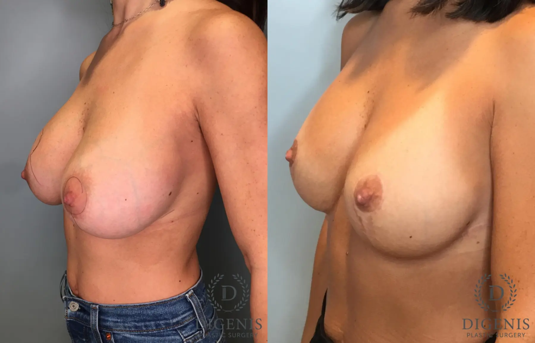 Breast Augmentation: Patient 32 - Before and After 2