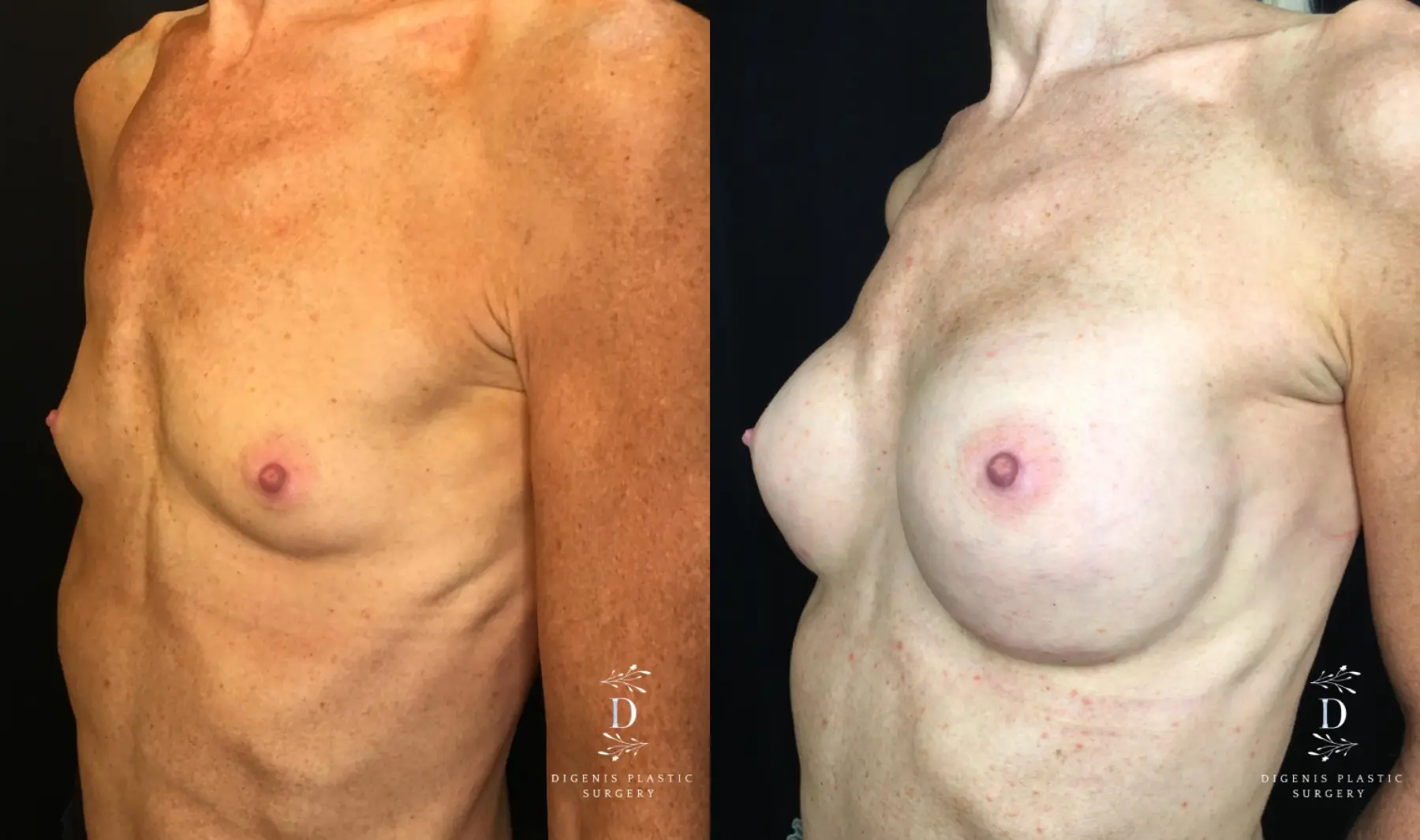 Breast Augmentation: Patient 20 - Before and After 4