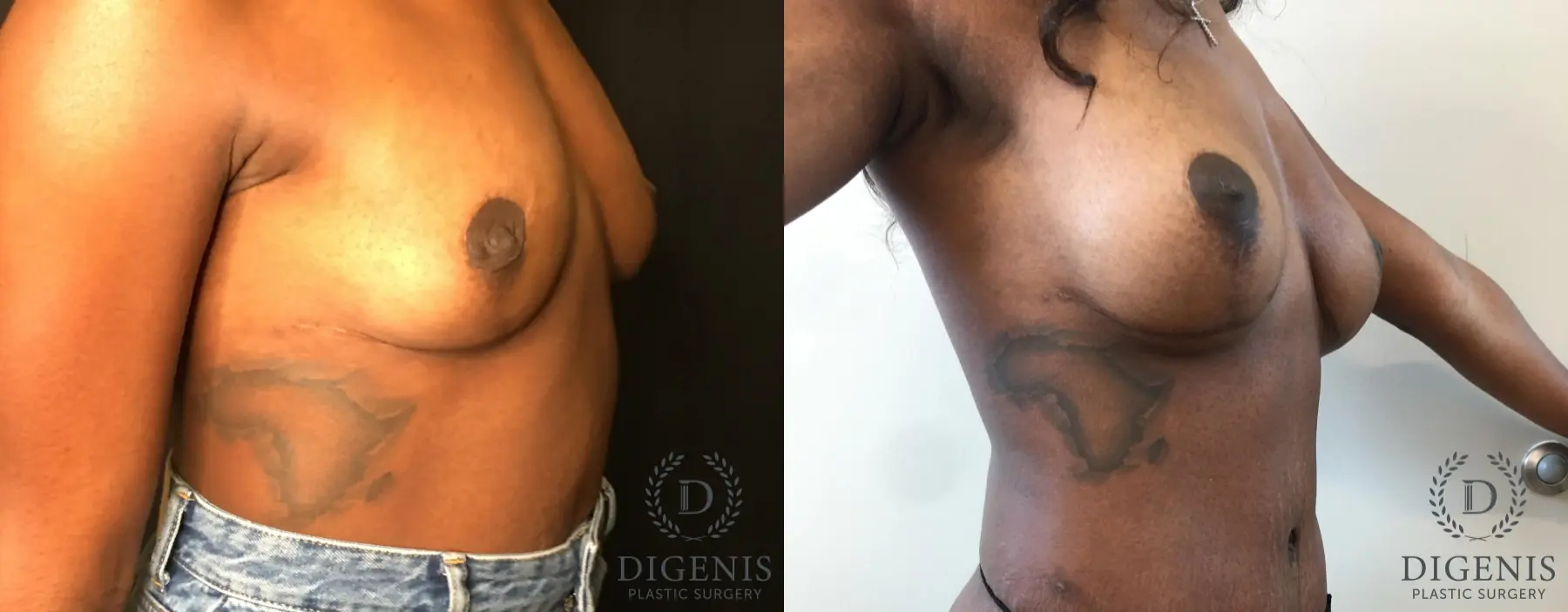 Breast Augmentation: Patient 27 - Before and After 2