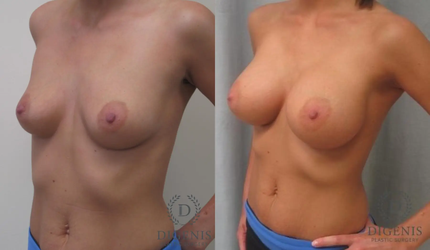 Breast Augmentation: Patient 6 - Before and After 2