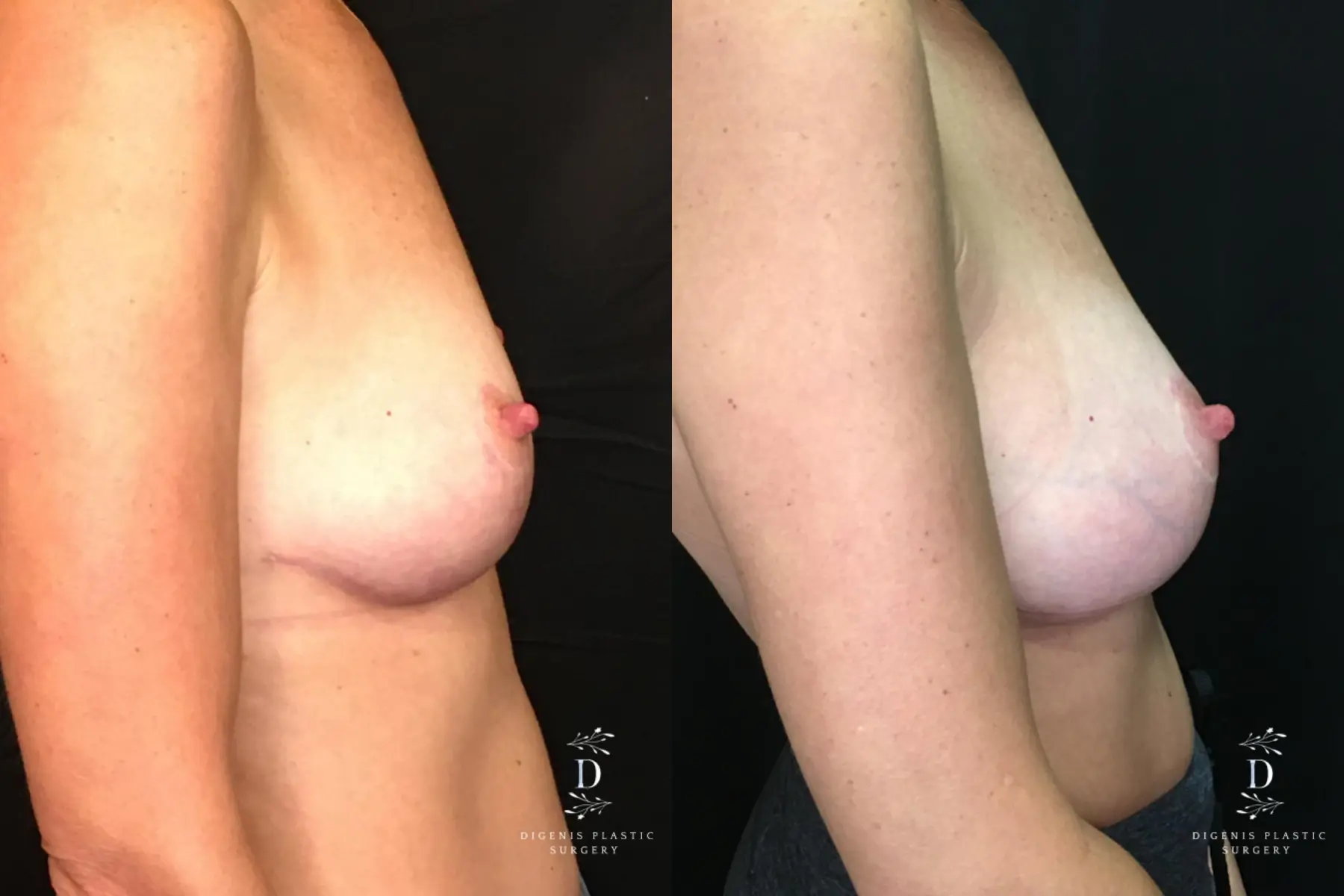Breast Augmentation: Patient 22 - Before and After 3