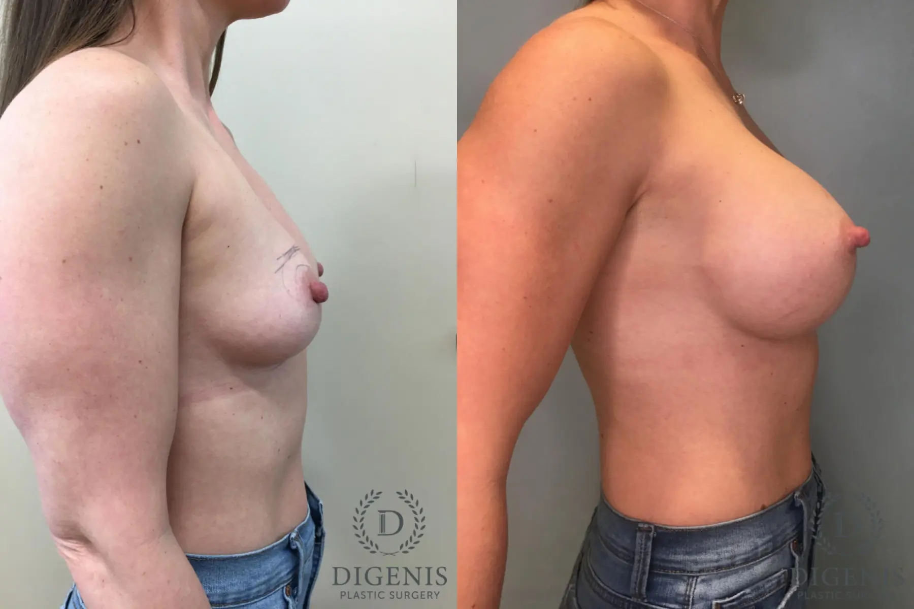 Breast Augmentation: Patient 27 - Before and After 3