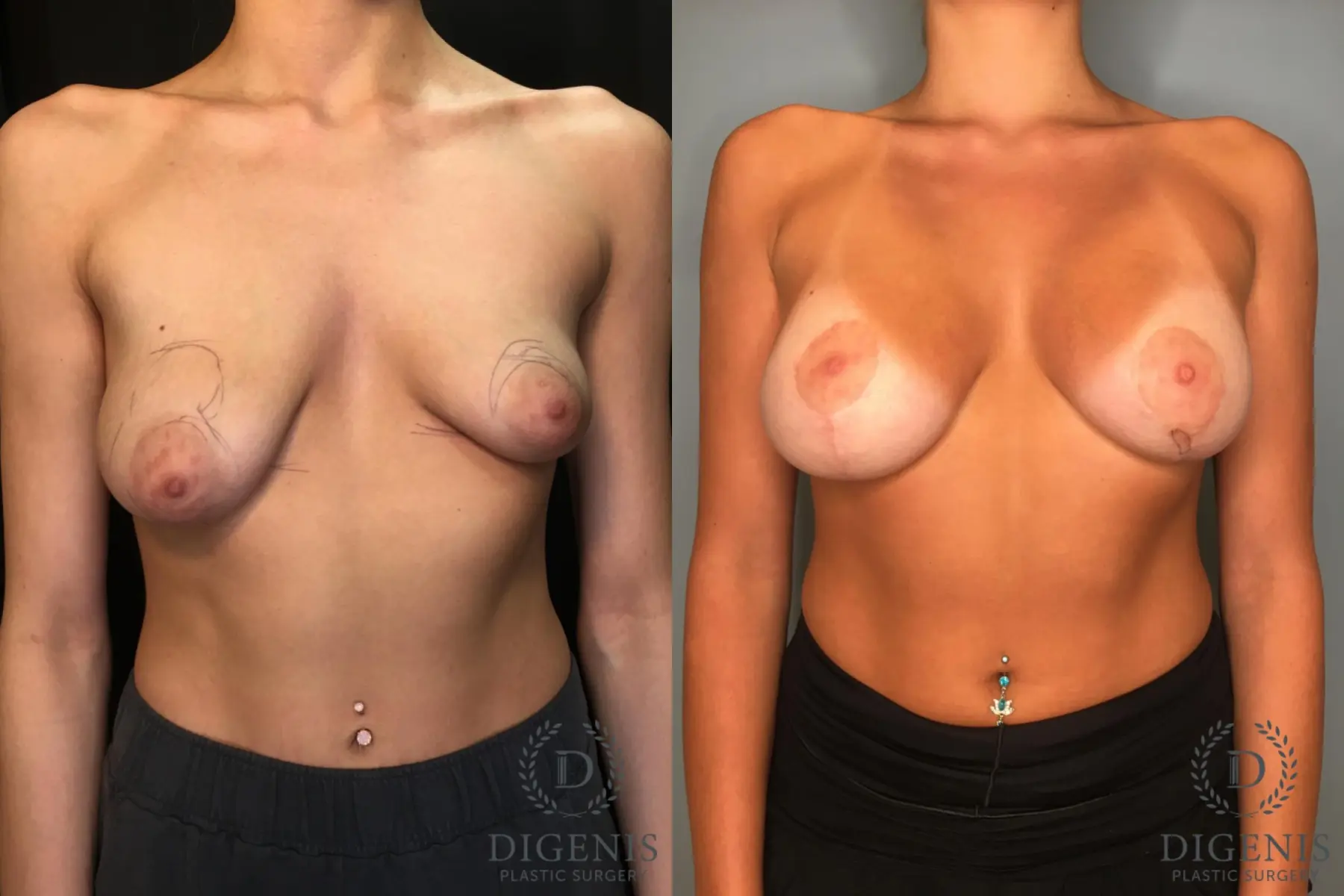 Breast Augmentation: Patient 31 - Before and After  