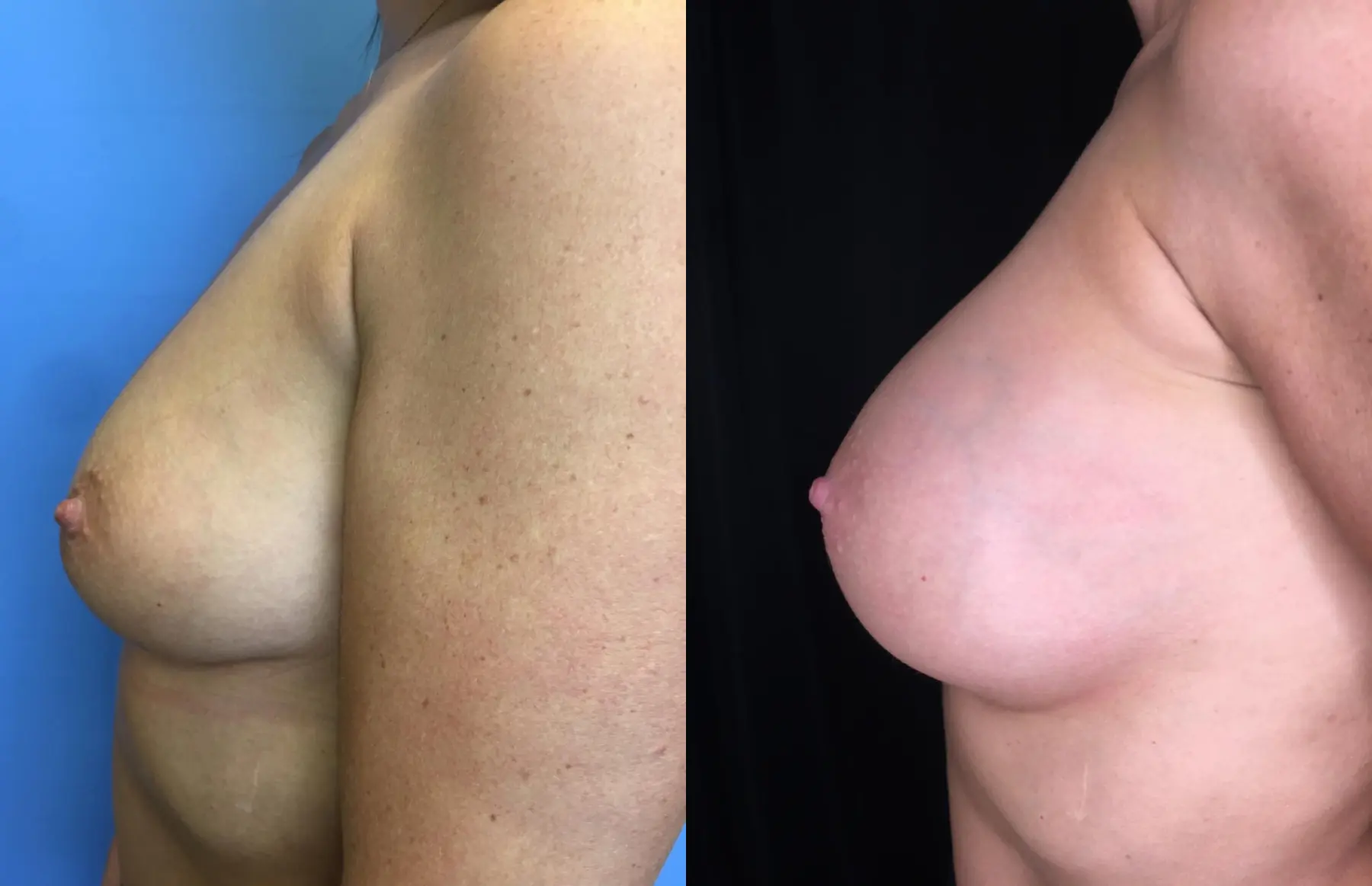 Breast Augmentation: Patient 21 - Before and After 5