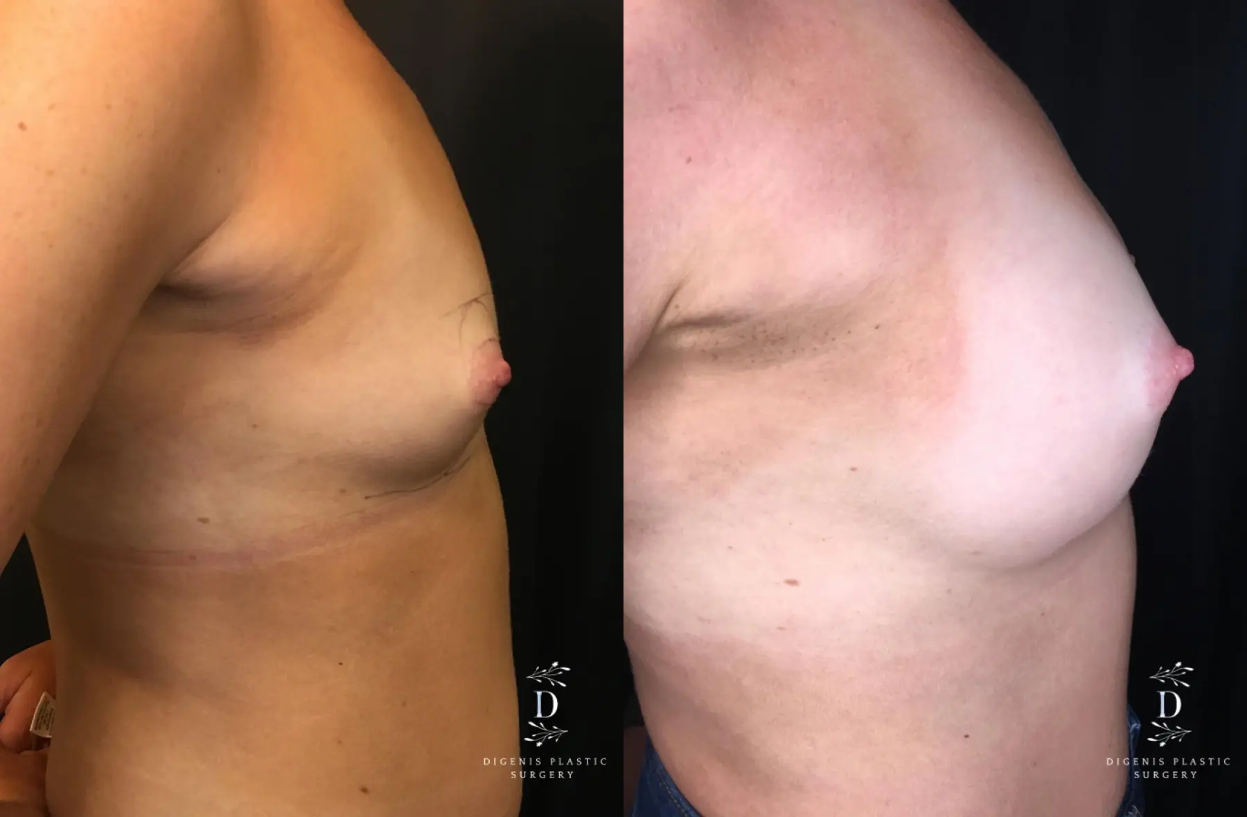 Breast Augmentation: Patient 19 - Before and After 3