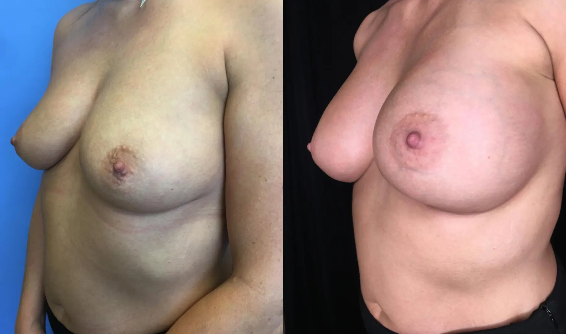 Breast Augmentation: Patient 21 - Before and After 4